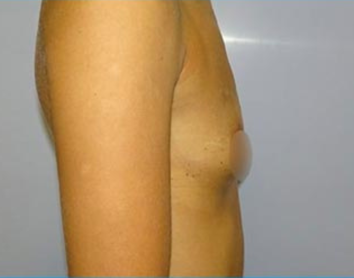 Antes del aumento de senos