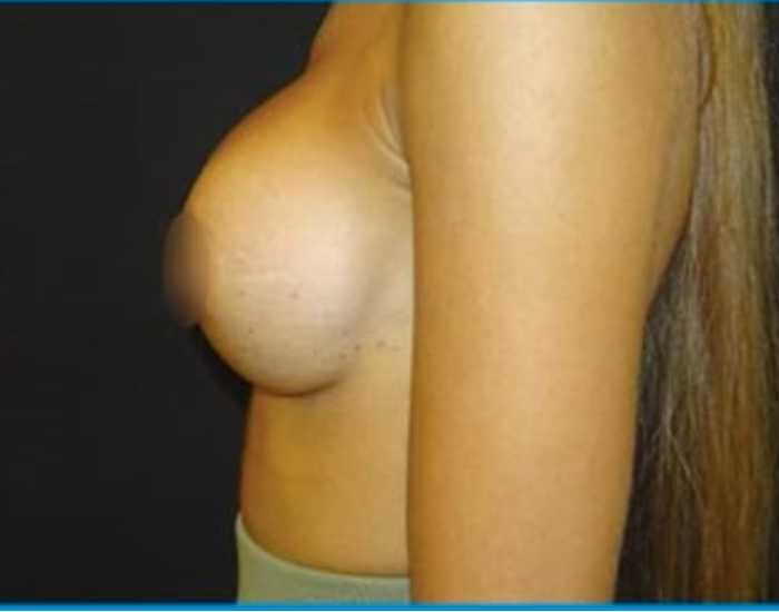 Después del aumento de senos