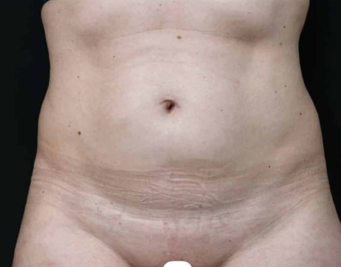 Antes de la lipoescultura