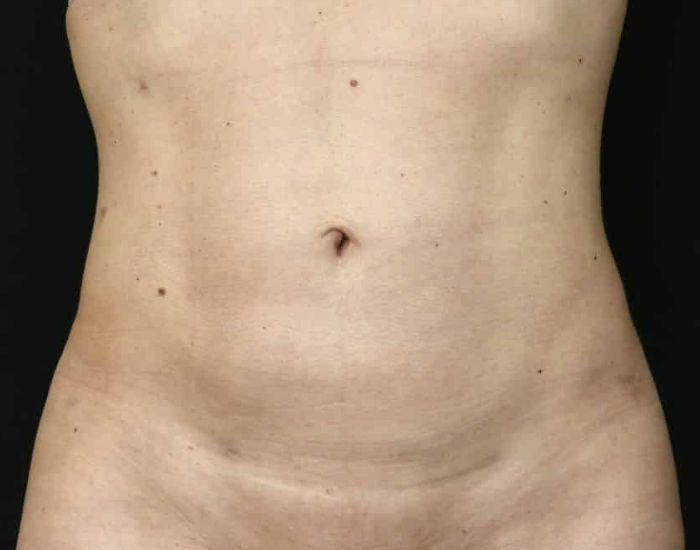 Después de la lipoescultura