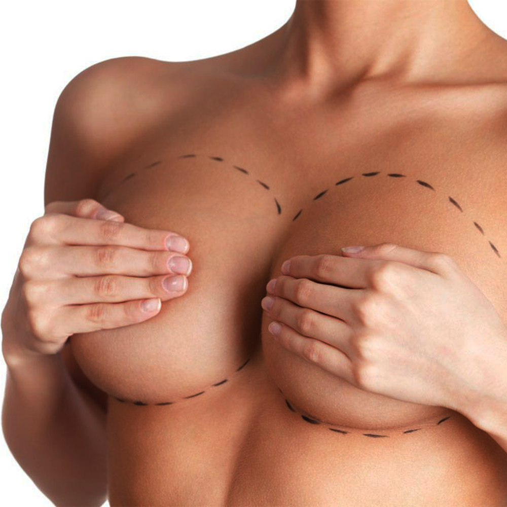 Mamoplastia de aumento
