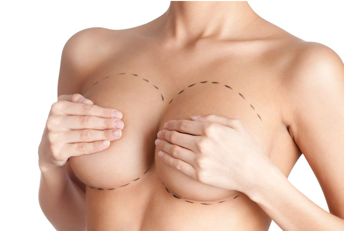 Mamoplastia